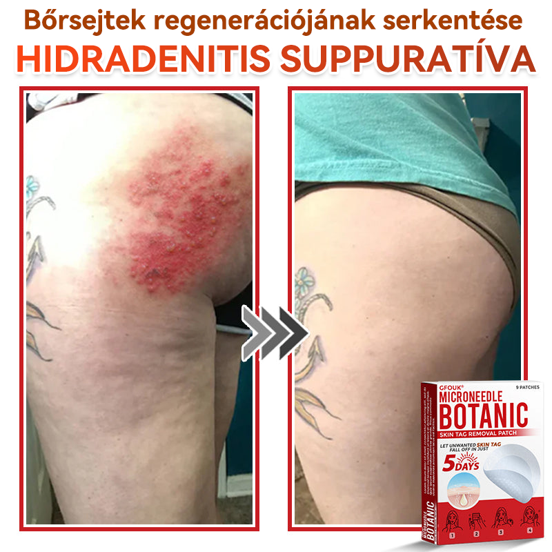 ✅ GFOUK® Mikrotűs növényi bőrkinövés eltávolító tapasz