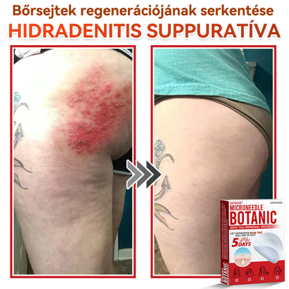 ✅ GFOUK® Mikrotűs növényi bőrkinövés eltávolító tapasz