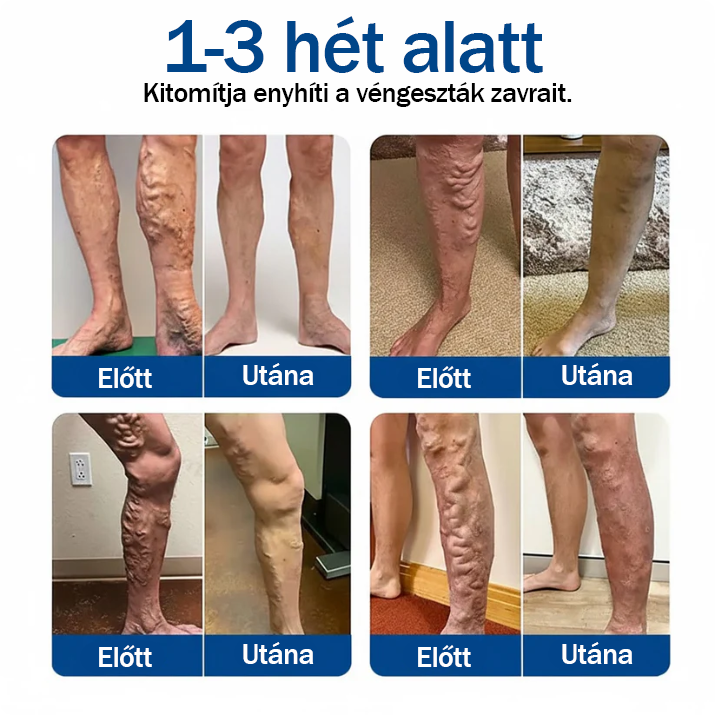 ☘️☘️🇭🇺👨‍⚕️✅TAILEDEN® VeinEase Mikrotűs Kezelő Tapasz⚡Azonnali Megkönnyebbülés, Hosszú Távú Eredmények