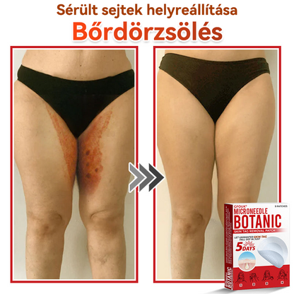 ✅ GFOUK® Mikrotűs növényi bőrkinövés eltávolító tapasz