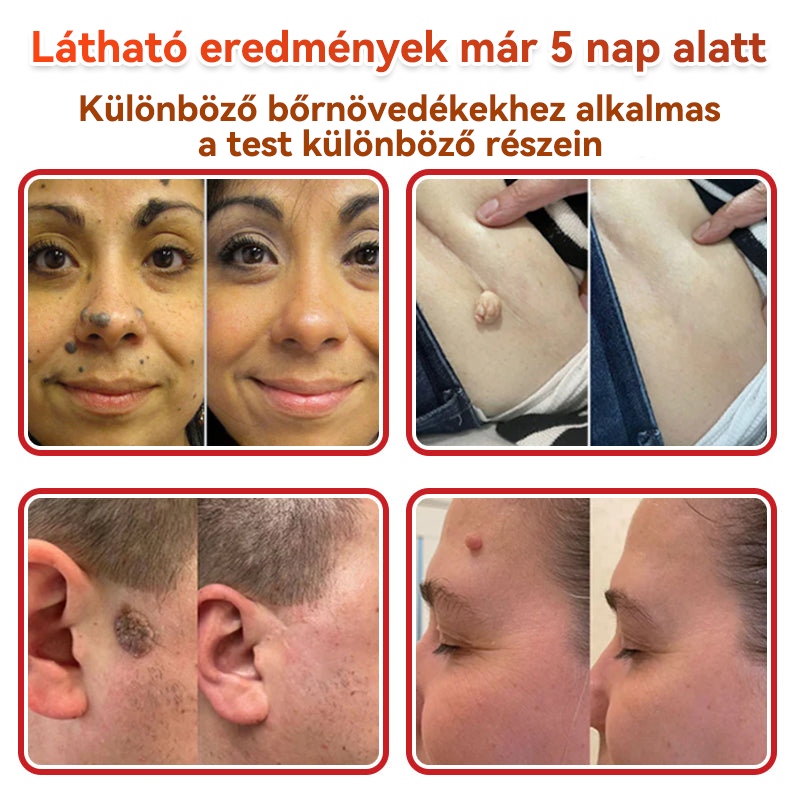 ✅ GFOUK® Mikrotűs növényi bőrkinövés eltávolító tapasz
