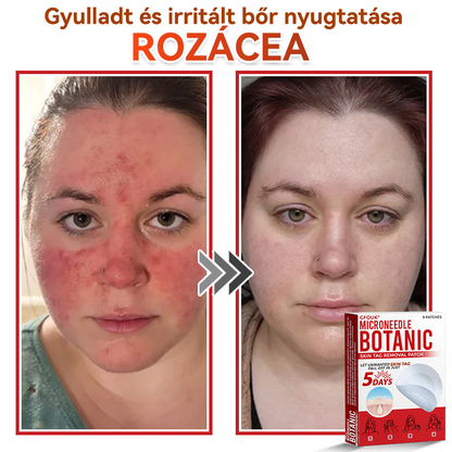 ✅ GFOUK® Mikrotűs növényi bőrkinövés eltávolító tapasz